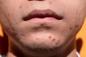 acne in chin