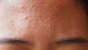 acne vulgaris and black spots over whole face of Southeast Asian woman  Acne occurs when hair follicles become plugged with oil and dead cells It  cau Stock Photo  Alamy