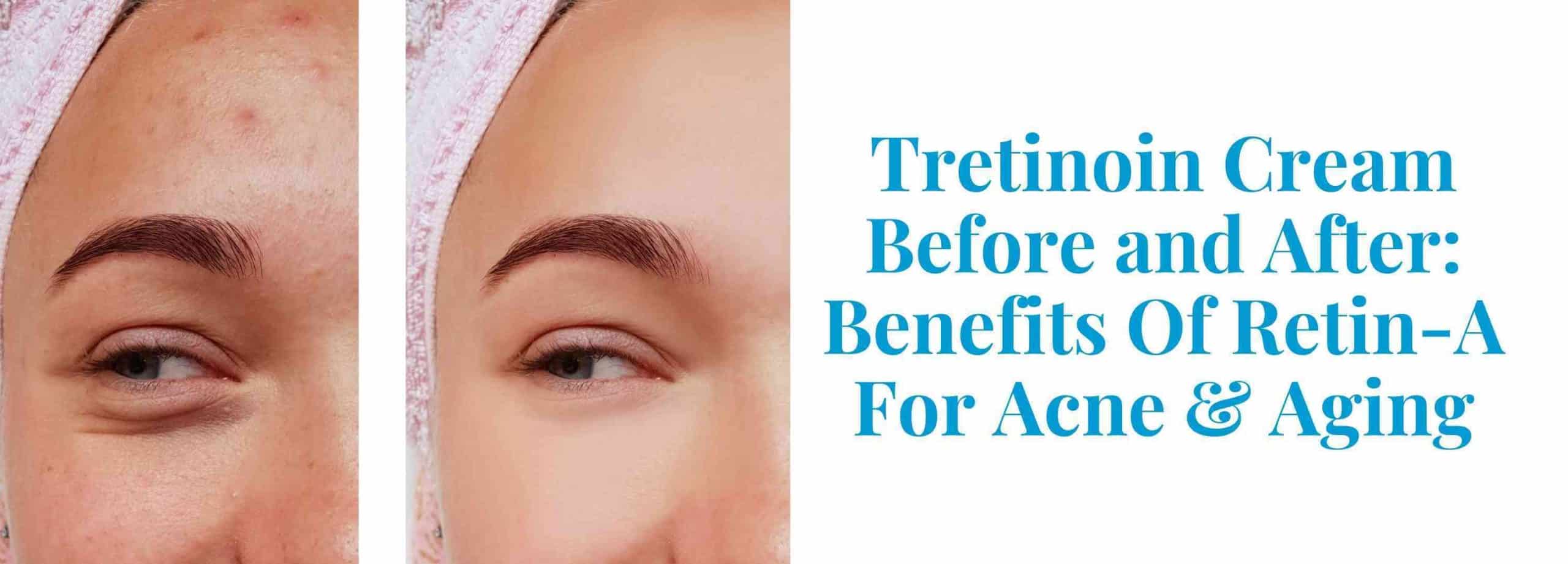 Tretinoin Before and After Benefits Of Retin-A- Pandia Health photo