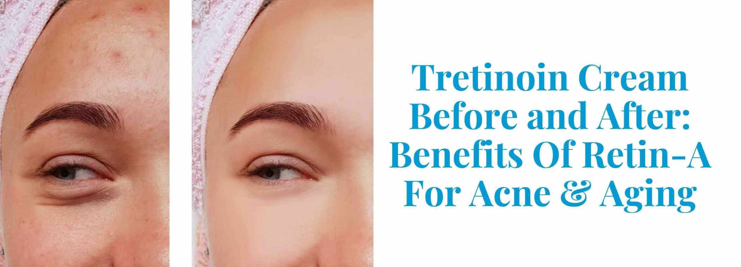 Tretinoin Before After Benefits Of Retin A Pandia Health Tretinoin Before After Benefits Of Retin A Pandia Health