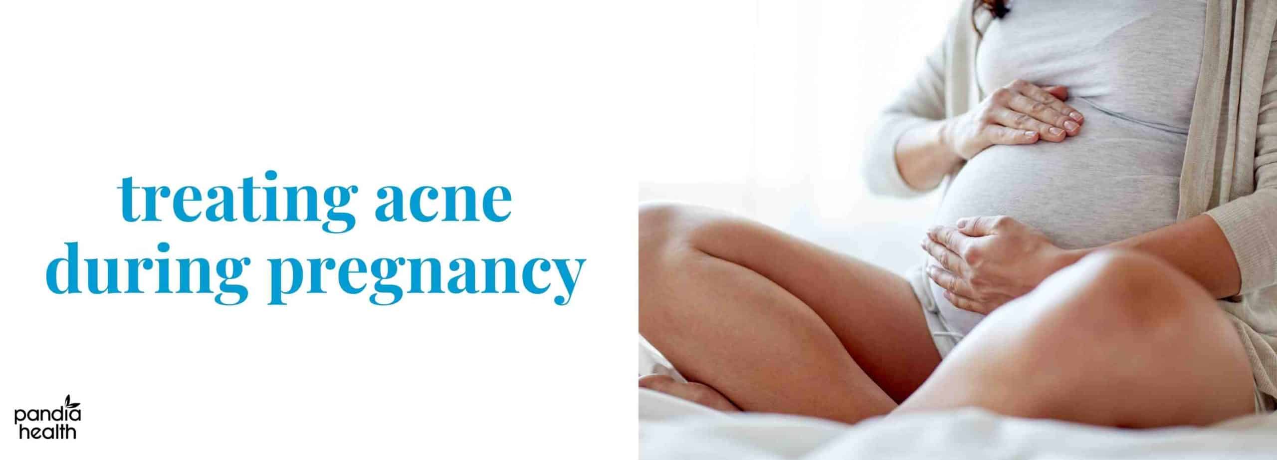 treating acne during pregnancy