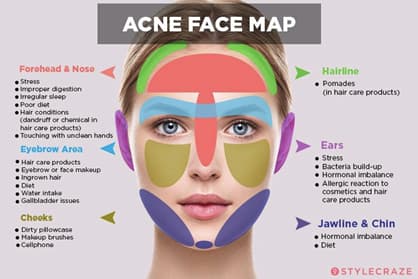 Face Map of Acne