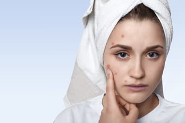 Top 20+ why do i get acne on my cheeks 2 What Does Acne on your Cheeks Mean?