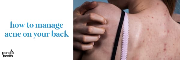 Back Acne in Females: Causes and Treatment | Pandia Health