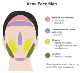 Chin Acne Face Map