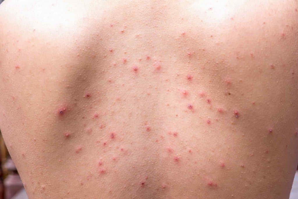 What Causes Back Acne Treating Female Bacne Pandia Health