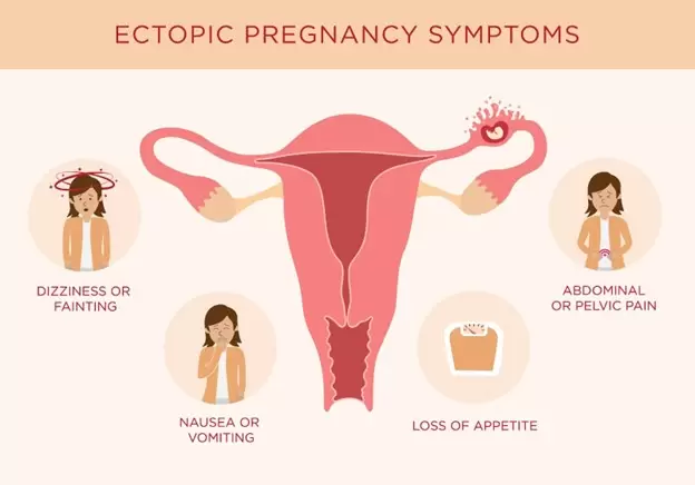 ectopic pregnancy symptoms diagram