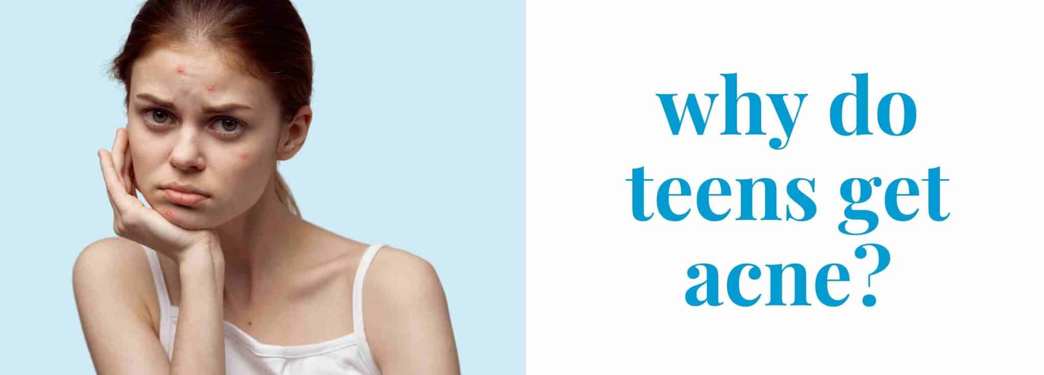 Why Do Teenagers Get Acne? Causes, Prevention And Treatment