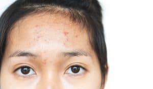 Forehead acne