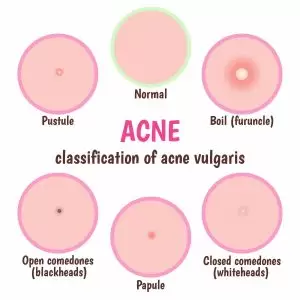 acne vulgaris types