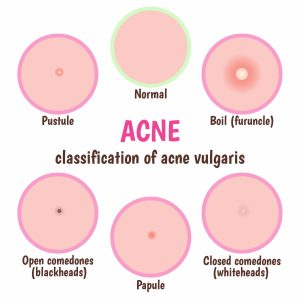 acne vulgaris types