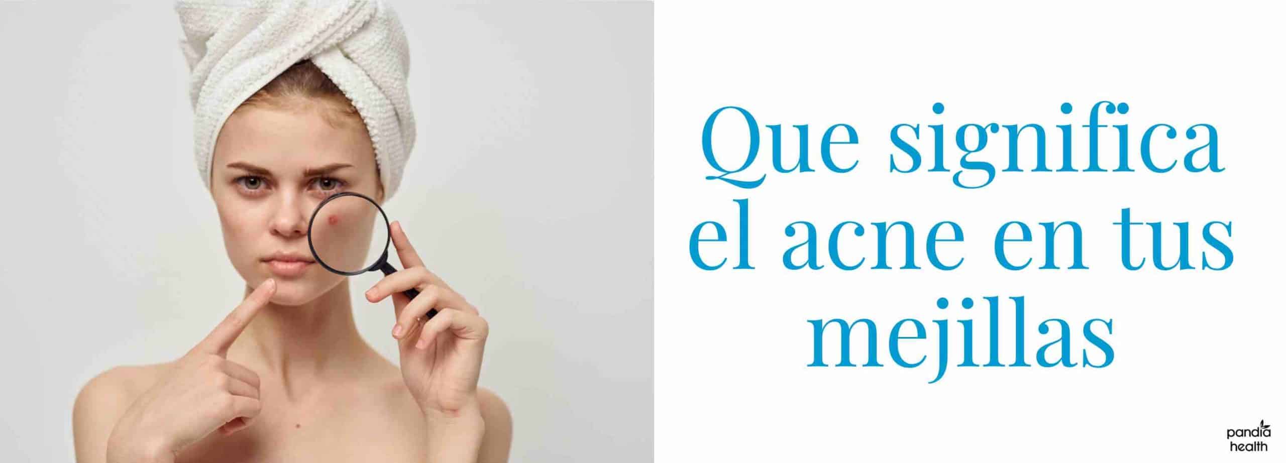 ¿Qué significa tener acné en las mejillas?