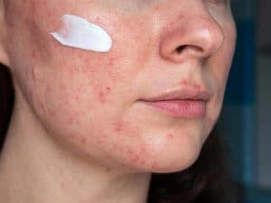 acne skin treatment