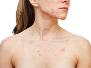 women with acne on chest