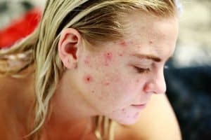 girl with acne on face