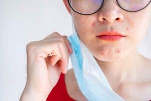 women holding mask with acne