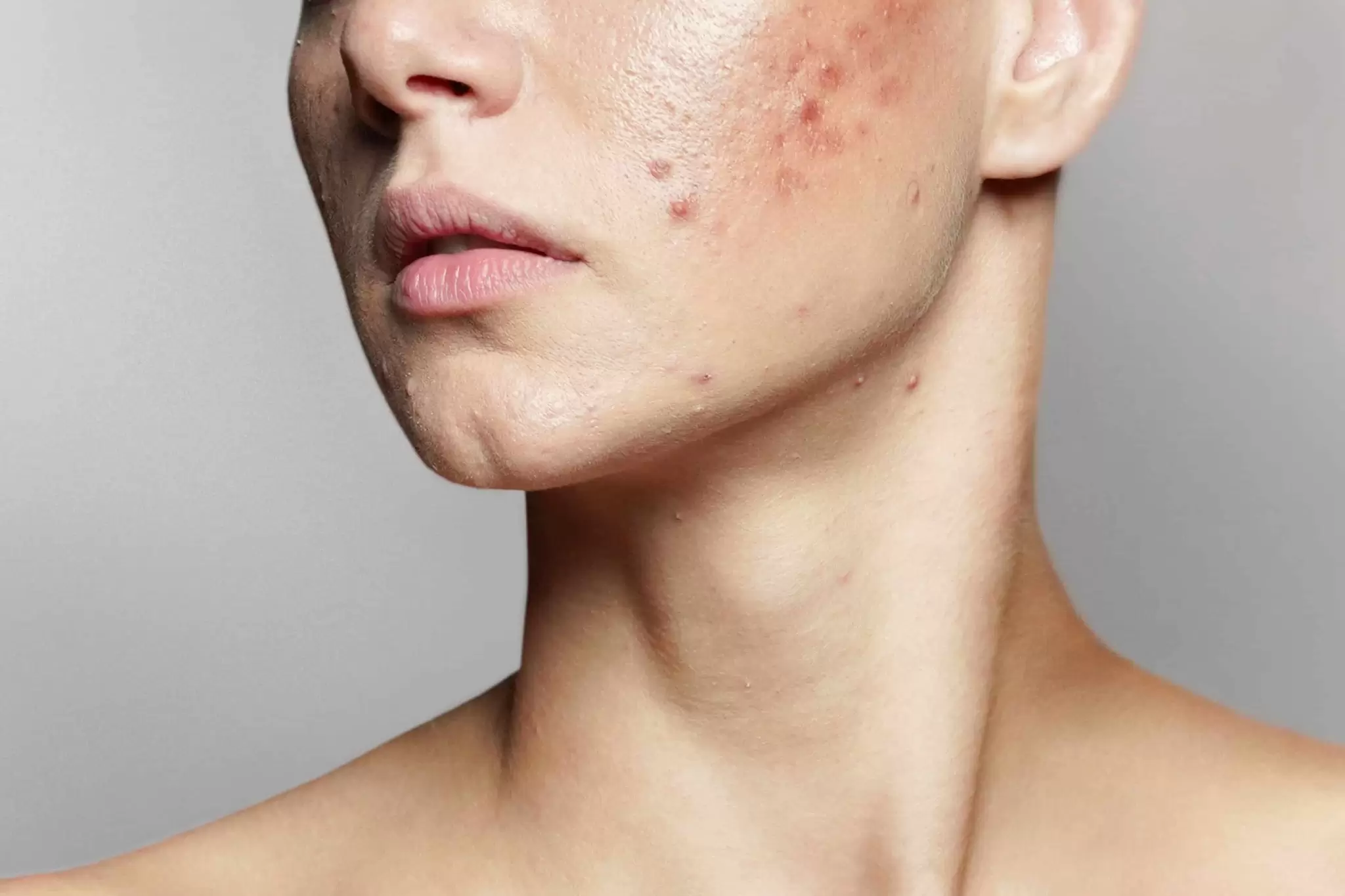 Jawline Acne Causes, Prevention & Tips For Quick Relief
