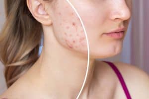 Woman with acne on cheeks