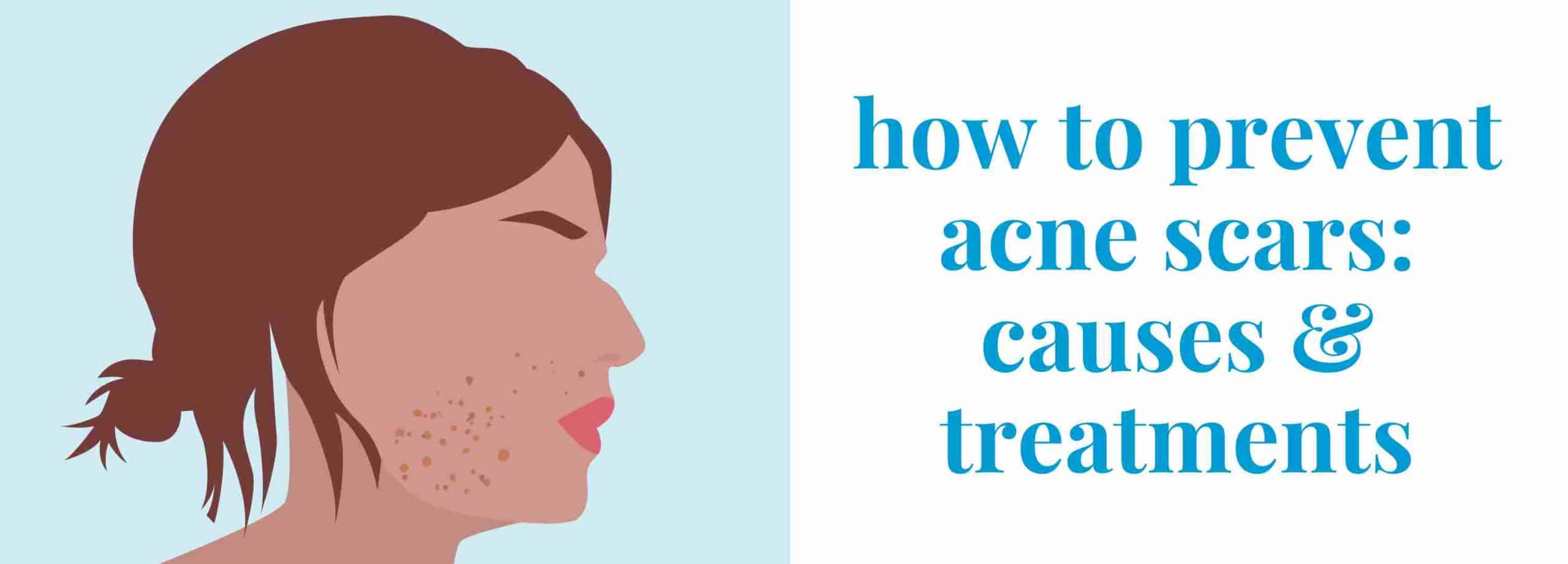 how to prevent acne scars: causes & treatment