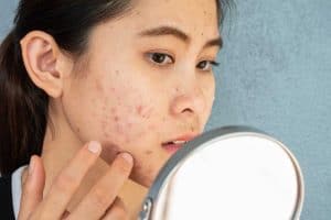 A woman with Acne on her cheeks