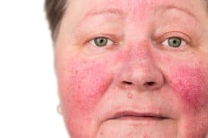 A woman with Rosacea on her cheeks