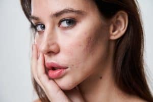 A photo showing a woman with acne scarring on her face