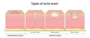 Image showing types of acne scars