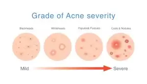 Types of Acne: Blackheads, Whiteheads, Pustules, Papules, Cysts, Nodules