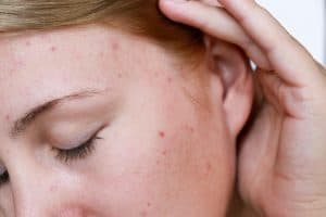 Woman cupping her ear and showing acne on her cheek