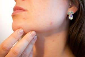 An image of a woman with jawline acne resting her fingers on her chin.
