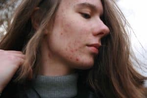 A photo showing a woman with acne scars and blemishes on her cheek