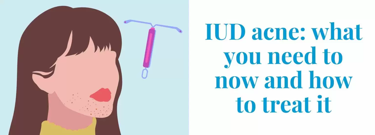 IUD acne: what you need to know and how to treat it