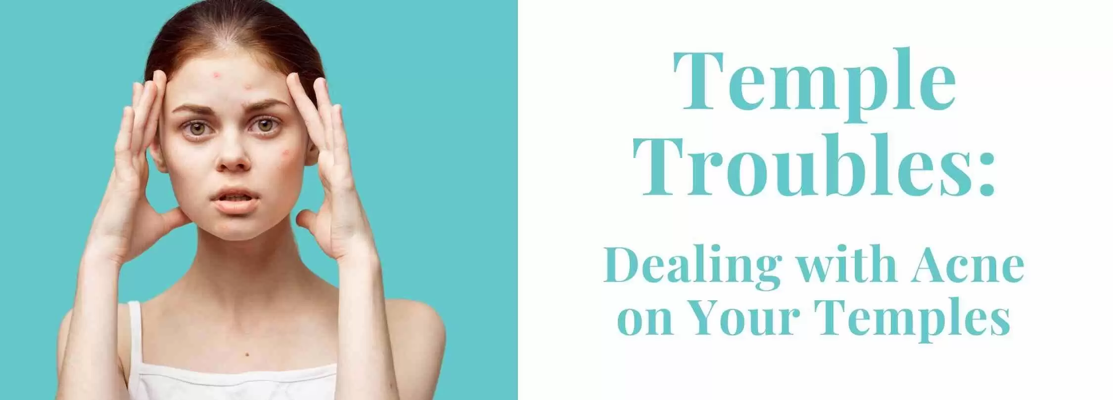 Teenager touching her temples with both hands. Temple Troubles: Dealing with Acne on Your Temples